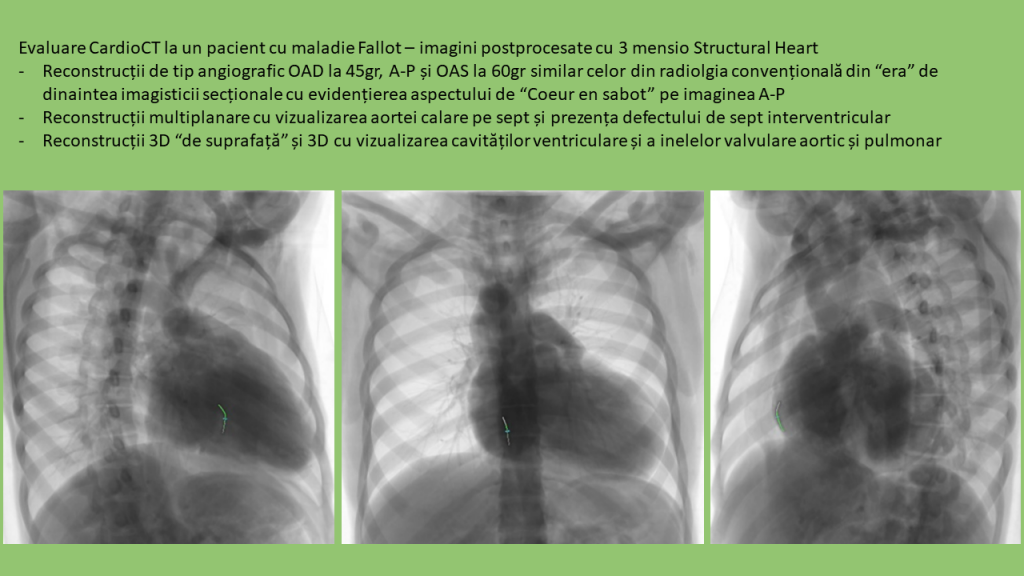 CardioCT - pacient cu Fallot