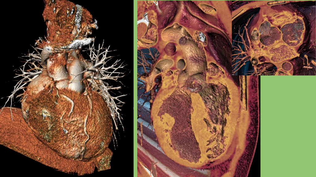 CardioCT - Fallot3