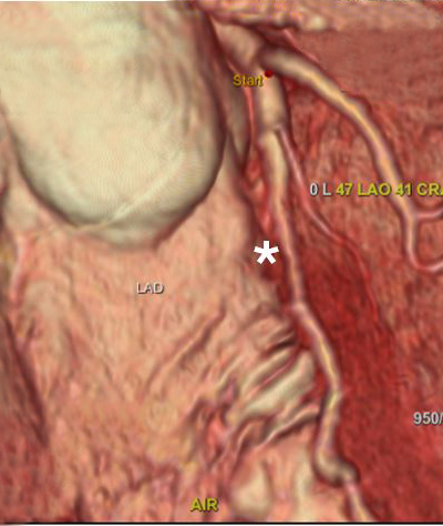 CT Cardiac