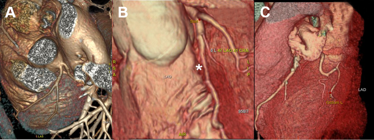 CT Cardiac