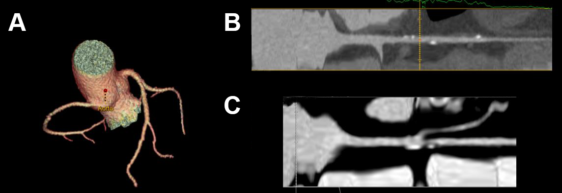 CT Cardiac