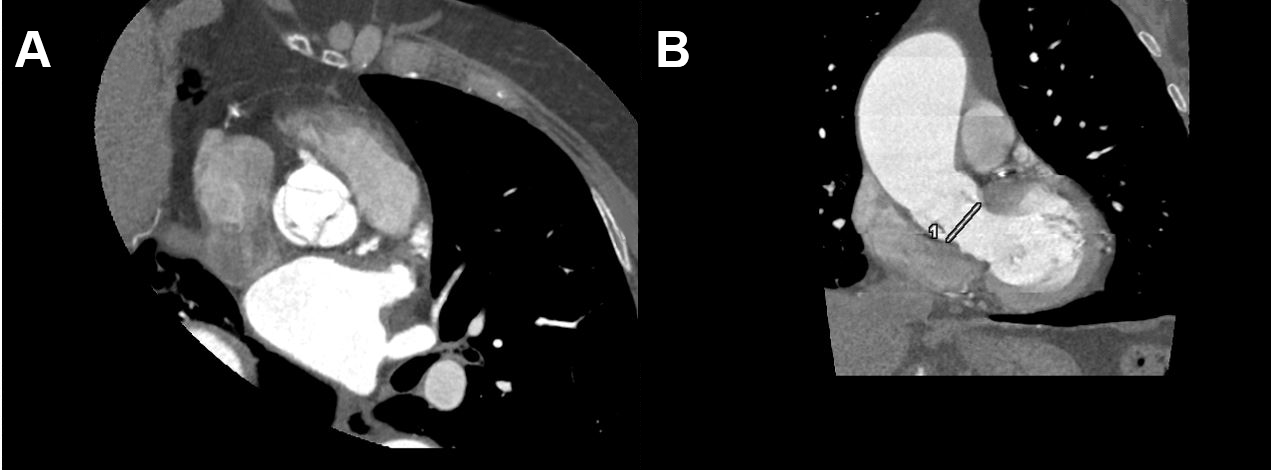 CT Cardiac