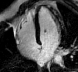 rmn cardiac