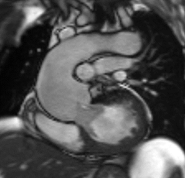 rmn cardiac