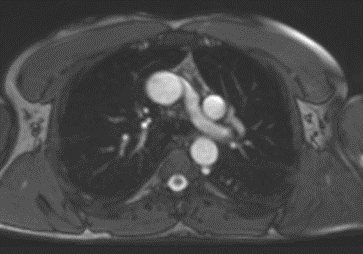 rmn cardiac