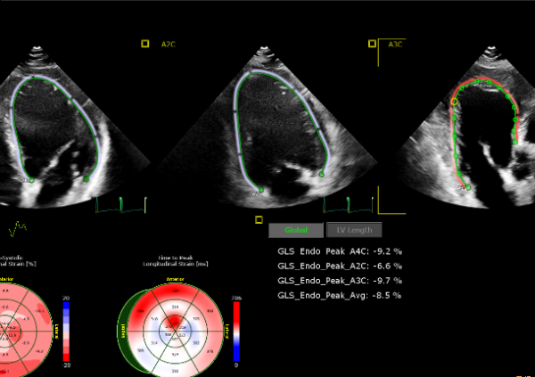 ecocardiografia