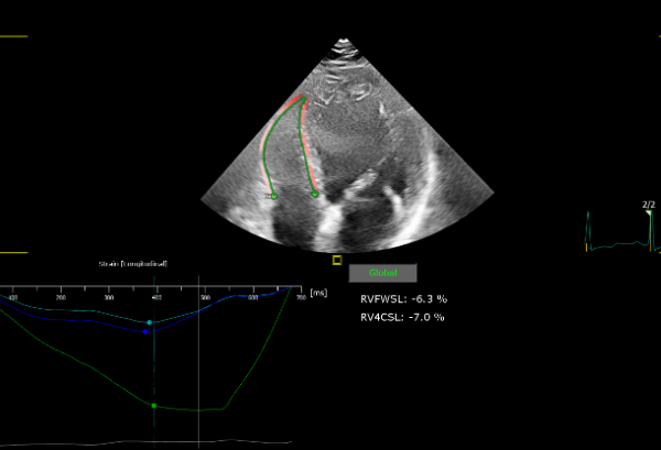 ecocardiografia