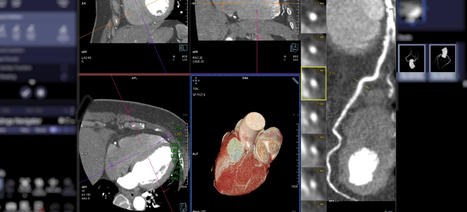 diagnostic boala coronariana