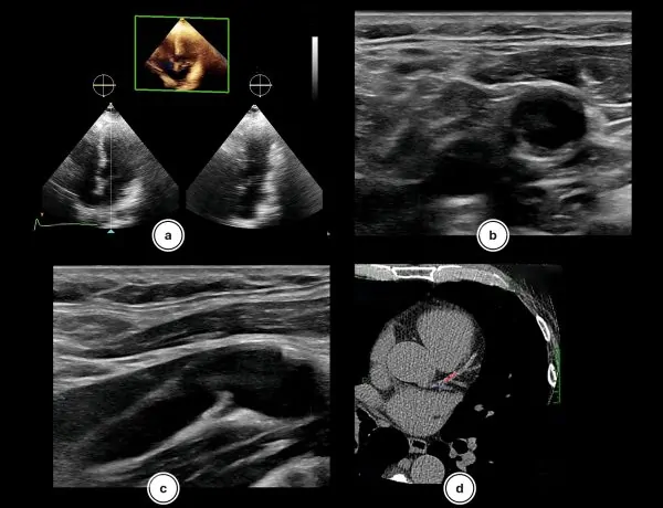 Risc cardiovascular personalizat - investigatii inima