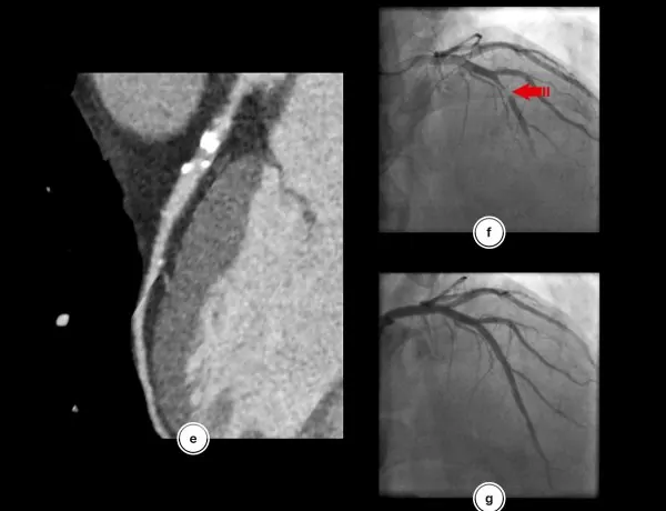 Risc de infarct - investigatii necesare cardiologie