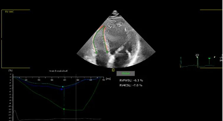 ecocardiografia